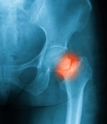 Të mbijetuarit nga kanceri janë më të rrezikuar për fraktura të kockave